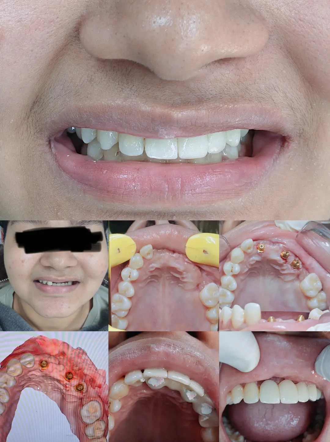 Clinical sequence showing planning, placement, and restoration of anterior dental implants